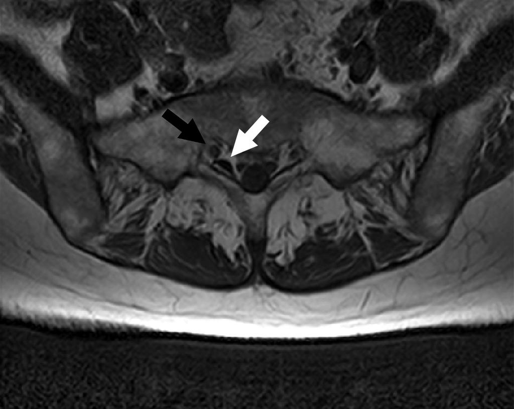 Lee, et al / Air Trapping after Caudal Epidural Injection in the right leg and numbness in the S1 dermatome area as a possible consequence of a small volume of trapped air from the caudal epidural