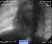Valvular AS (neonates) Balloon Aortic Valvotomy NOT AS SUCCESSFUL AS PTMC/PBV If symptomatic or there is evidence of left ventricular dysfunction/mild left ventricular hypoplasia (Class I) FAILED TO