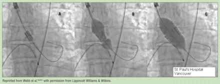 aorta /LV Technical difficulties Patients with AR dilated aortic root is a limitation Patients with AS risk of calcium emboli during dilatation Contraindications Severe iliofemoral disease Very small