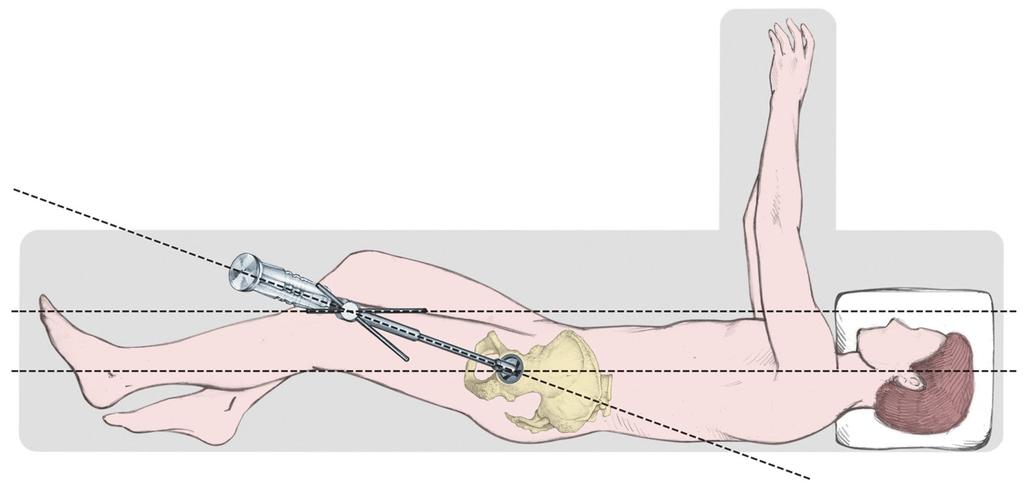 Metal shell anteversion is set at approximately 20 by moving the cup impactor so that the left/right anteversion rod is parallel to the long axis of the patient (Figure 12).
