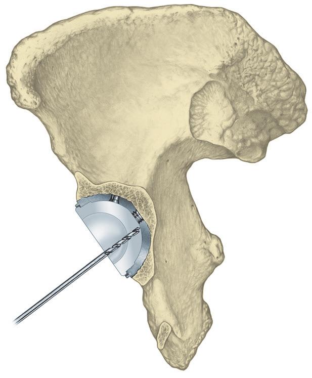 Trident Acetabular System Hemispherical Surgical Protocol Removal of the Insert and Shell (cont.