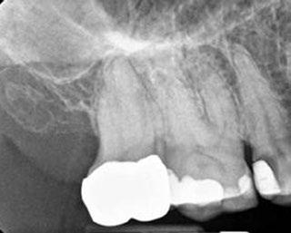 Condensing Osteitis is a diffuse radiopaque lesion representing a localized bony reaction to a low-grade inflammatory stimulus usually seen at the apex of the tooth. Diagnostic Case Examples Fig. 1.