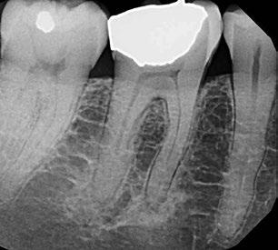 Now there is no response to thermal testing and there is tenderness to biting and pain to percussion. Radiographically, there are diffuse radiopacities around the root apices.