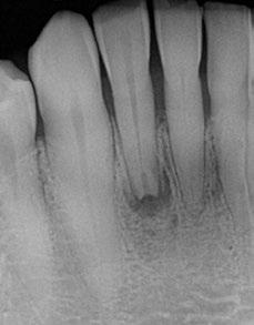 Upon application of Endo-Ice on this tooth, the patient experienced pain and upon removal of the stimulus, the discomfort lingered for 12 seconds.