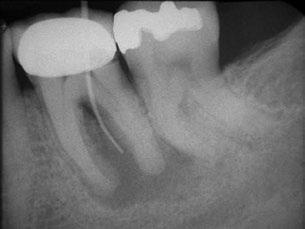 Fig. 5. Mandibular left first molar demonstrates a relatively large apical radiolucency encompassing both the mesial and distal roots along with furcation involvement.
