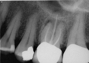 There was a draining sinus tract on the mid-facial of the attached gingiva which was traced with a gutta-percha cone. There was recurrent caries around the distal margin of the crown.