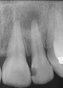 Maxillary left first molar was endodontically treated more than 10 years ago. The patient is complaining of pain to biting over the past three months.