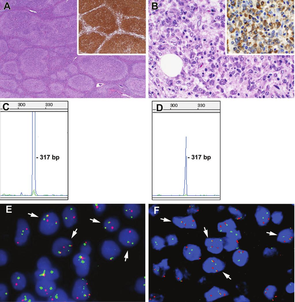 Figure 1. Pathologic and genetic evaluation of histiocytic transformation of follicular lymphoma (FL).