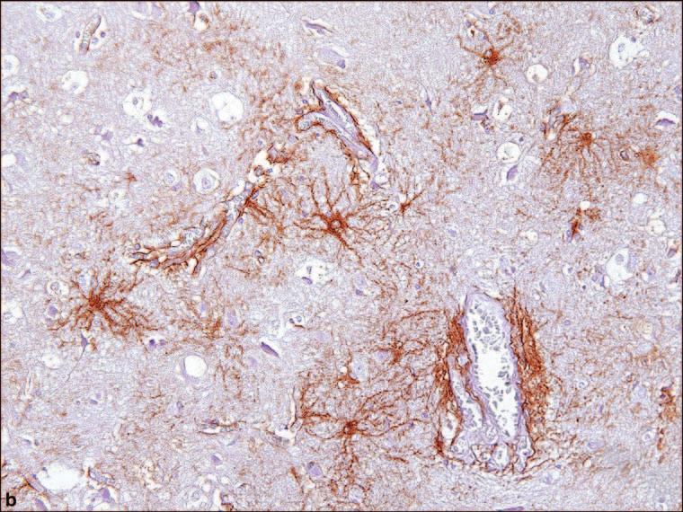usually signify chronic gliosis (Figure 1.9).