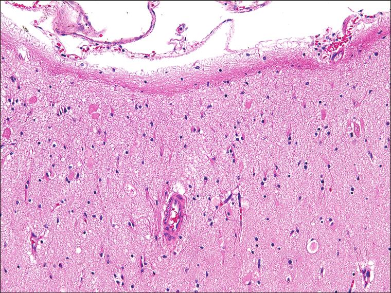 Cambridge University Press NORMAL ANATOMY AND HISTOLOGY OF THE CNS Figure 1.8. Dense subpial or interface (Chaslin s) gliosis.