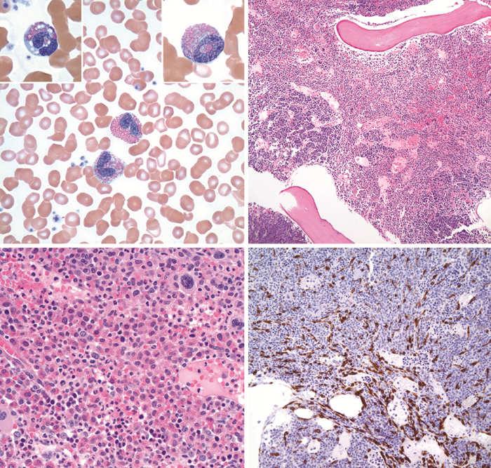 Myeloid and lymphoid neoplasms with eosinophilia and abnormalities of PDGFRA, PDGFRB, or FGFR1 Share similar molecular and biologic features Appear to involve pluripotent stem cell with both lymphoid