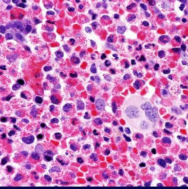 Myeloid/lymphoid neoplasms with PDGFRA rearrangement Patients present with chronic eosinophilia and elevated serum tryptase levels Bone marrow mast cells are increased, but are diffuse and not
