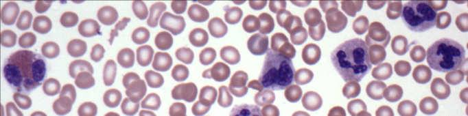 Myeloid/lymphoid neoplasms with