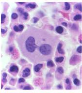 Reactive eosinophilia -Abnormal T-cell clone Algorithm for