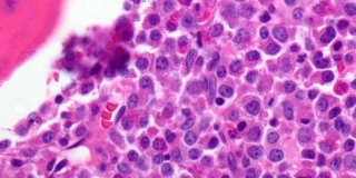 myeloid forms Basophilia and eosinophilia