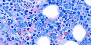 Required at diagnosis Bone marrow biopsy and aspirate Reticulin stain to assess baseline fibrosis level
