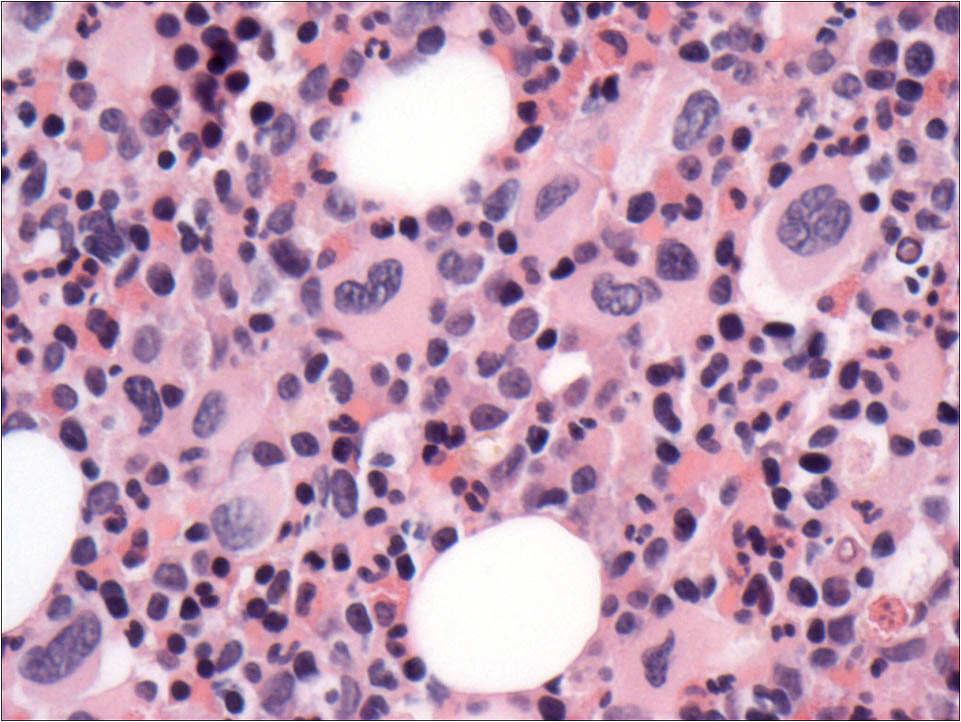 Chronic neutrophilic leukemia Rare MPN with leukocytosis (>25 x 10 9 /L) No dysplasia (hypogranulation) of