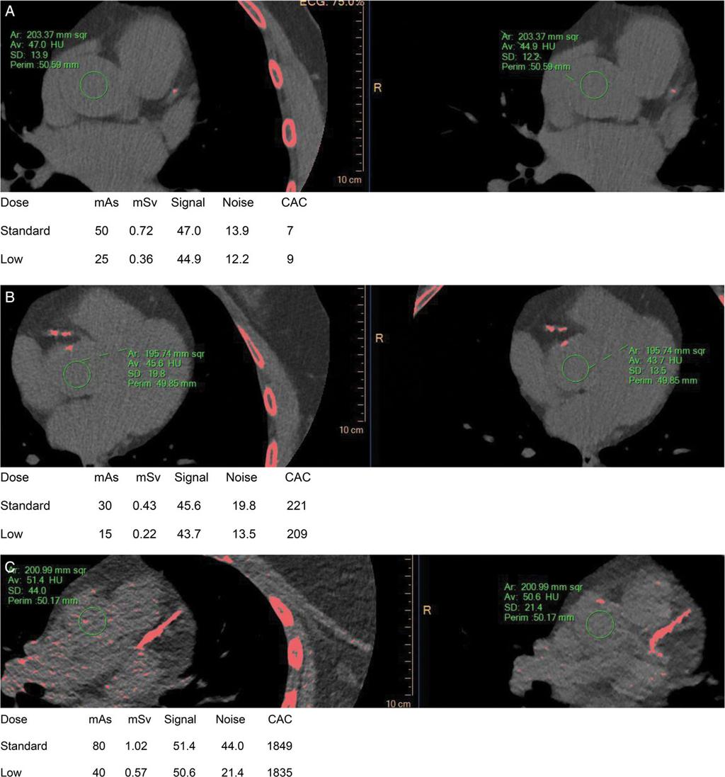 360 H.S. Hecht et al. Figure 1 Examples of standard- and low-dose scans in patients of varying body habitus and CAC scores.