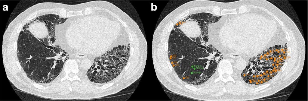 Ash et al. Respiratory Research (2017) 18:45 Page 4 of 11 Fig. 2 a Sample slice for CT scan of a subject.