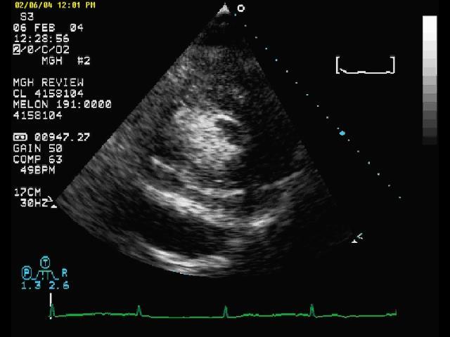 Cardiogenic shock post-mi free wall rupture Elderly diabetic woman with several days of