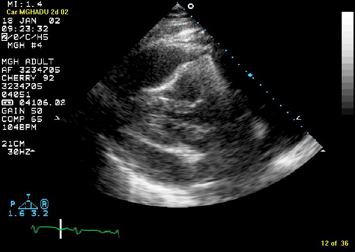 Cardiac Tamponade Echocardiographic findings in Cardiac Tamponade Pericardial effusion RV free wall inversion early diastole, respiratory variation RA inversion