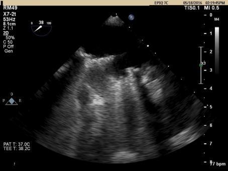 TTE 45 Small LV IVS flattening in diastole and systole RV volume and pressure overload Aortic bileaflet