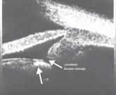 539 Fig. 1. UBM photograph showing intralenticular foreign body plus localised zonular damage. Fig. 2.
