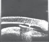 UBM photograph showing a glass foreign body (arrow) in the pupillary area with reverberation echoes behind it. Fig. 5.