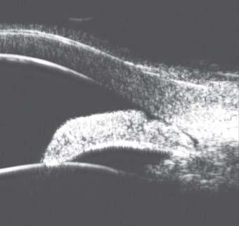 In Figure 27A, UBM examination revealed that the peripheral iris was closely contacted with the back of cornea (white arrowhead), anterior lens surface was