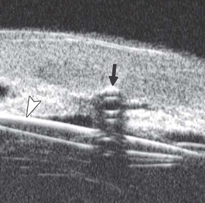 31A), fibrovascular membrane on the surface of ciliary body (white arrow in Fig. 31A) and choroidal effusion were also presented (white arrow in Fig. 31B).