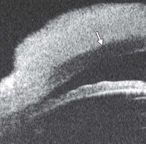 This neoplasm often affect conjunctiva or superficial layer of the cornea.