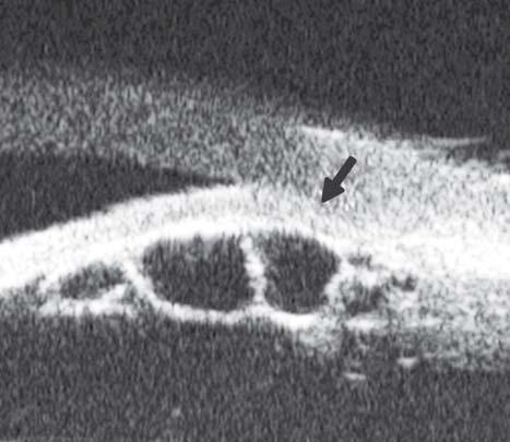 Slit lamp found a round-shaped yellow nodule on the temporal limbus. UBM image (Fig.
