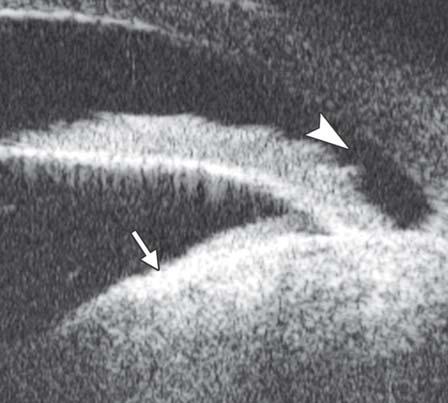 (white arrowhead) 46 Fig. 58: Iris melanoma Fig. 59: Ciliary body cyst Fig. 61: Choroidal melanoma. UBM examination shows the radial sectional image of a choroidal melanoma.