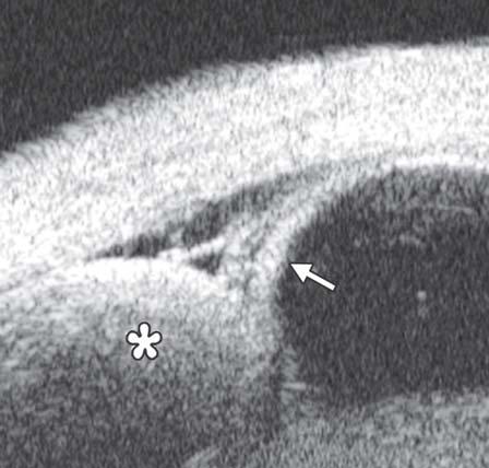 Secondary exudative retinal detachment occurred at the peripheral fundus (white arrow) conjunctiva were involved but not yet invade Bowman s membrane (white arrow).