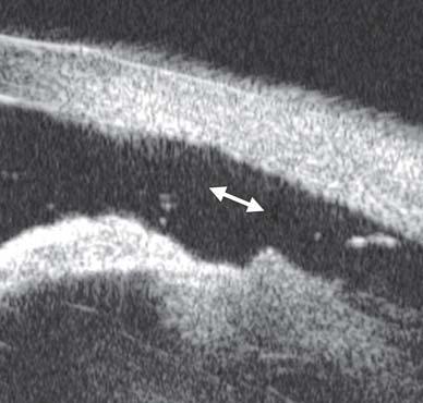 Fig. 66: Angle recession usually occurs in eye contusion.