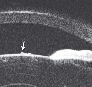 bridging peripheral iris and cornea (asterisk) Figs 77A to E: Exfoliation syndrome