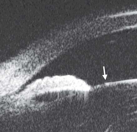 tissue strands bridging between peripheral iris and cornea and iris stromal defects.