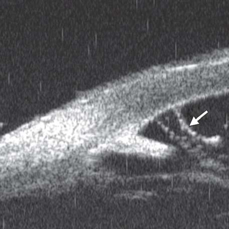 by white arrow represents anterior surface of lens); anterior chamber was filled with blood clot (asterisk) of various densities Fig. 9: Descemet s membrane detachment after phacosurgery.