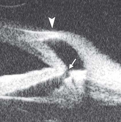Fig. 17: The UBM image shows the bulging of the limbal wall (white arrowhead)