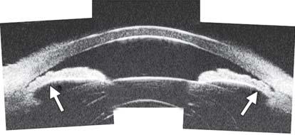 19: UBM image shows the axial ACD is equal to the central corneal thickness