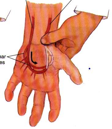 An assessment to determine whether your patient s ulnar & radial arteries are patent.