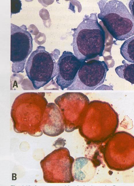 Acute myeloid leukemia with