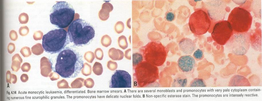 Acute myeloid leukemia with 11q23(MLL)