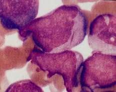 Acute Myeloid Leukemia with recurrent