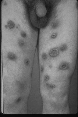 Systemic fungal infections: the true pathogens Histoplasmosis, Coccidioidomycosis, Blastomycosis Dimorphic Respiratory acquisition Restricted geographic distribution Infect normal hosts Disease