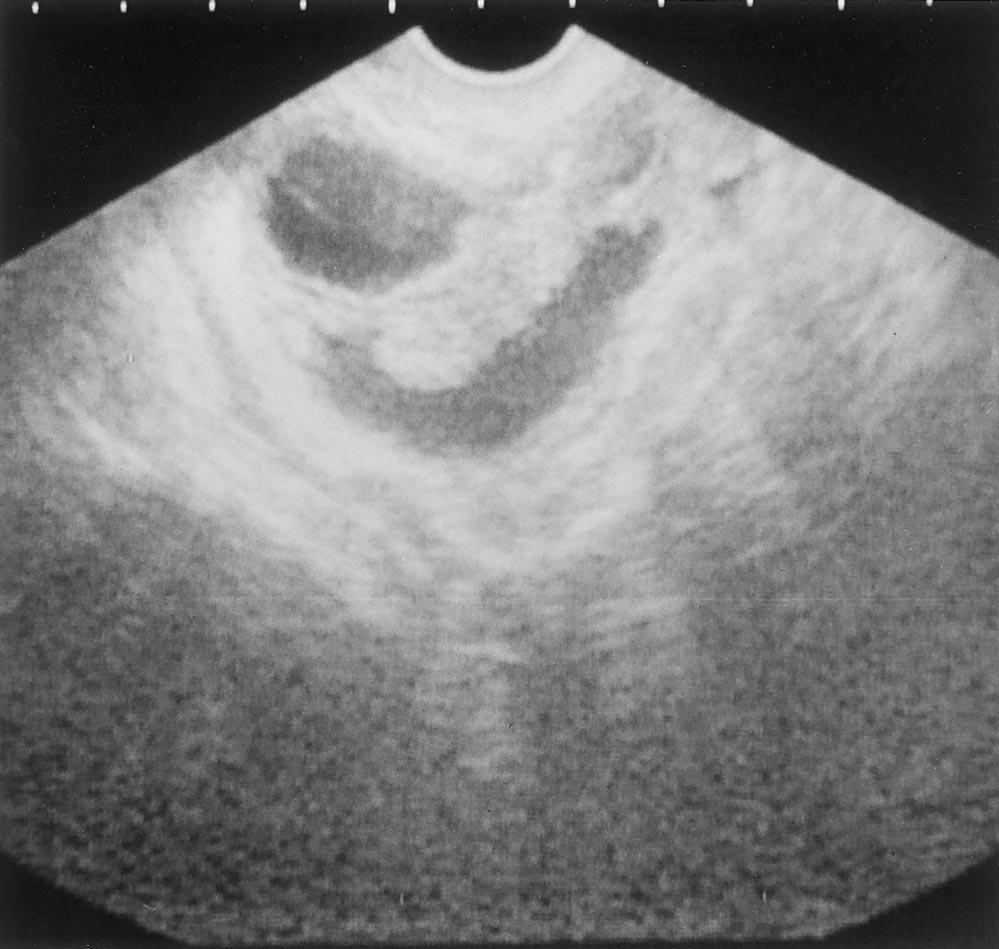 the hydrosalpinx more evident. Methods using the passage of air or fluid to visualize FIGURE 2 Hydrosalpinx diagnosed by transvaginal ultrasonography. Note the adjacent ovarian cyst.