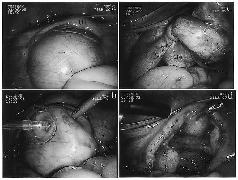 a: Pelvic cavity exhibited adhesions and a large cystic mass. b: The content of the cystic mass was aspirated by a double balloon catheter.