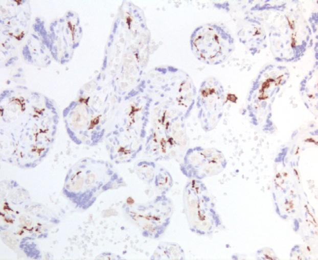 Placenta stained with anti-caveolin-1 Caveolin-1 was suggested as a useful marker for differentiating epithelioid mesothelioma from lung adenocarcinoma.
