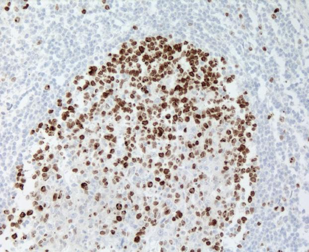 Ewing's sarcoma stained with anti-human DAX1 In human neoplasms, DAX-1 has been examined in several types of tumors.