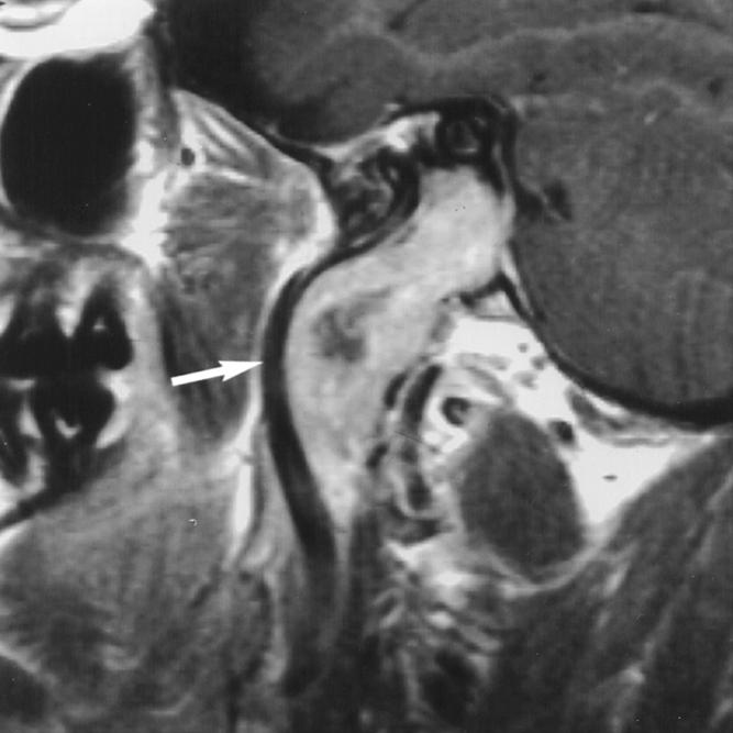 , oronal contrast-enhanced fat-saturated T1-weighted image shows intensely enhancing mass centered in jugular foramen (star) with superolateral spread into hypotympanum (arrow).